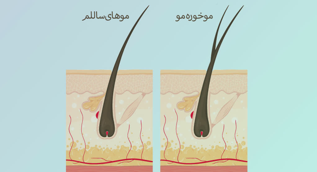 علل و معلول ایجاد موخوره - اصفهان زیبا