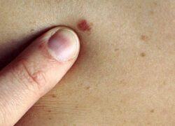پیشگیری از سرطان پوست با چند نکته ساده