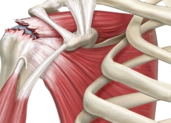 افزایش نگرانکننده موارد ابتلا به پارگی تاندون شانه افزایش نگرانکننده موارد ابتلا به پارگی تاندون شانه