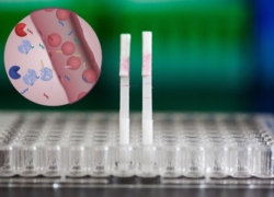 تشخیص زودهنگام سرطان در خانه با آزمایش ادرار